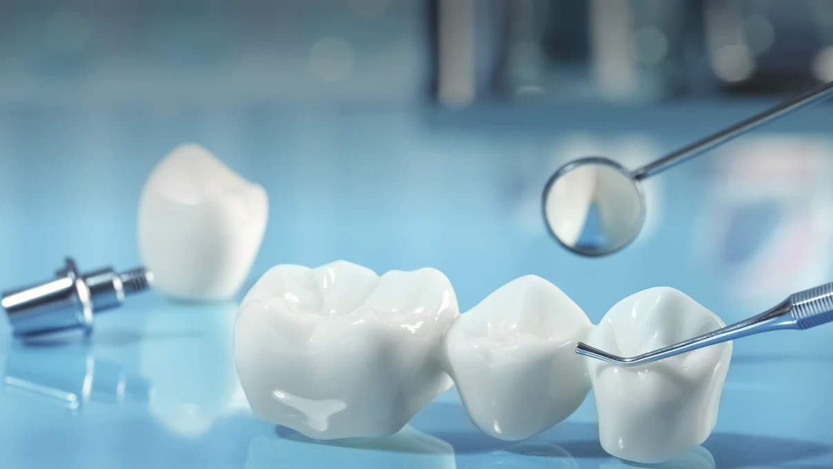 Bridge dentaire au Cabinet du Dr Domingues, chirurgien-dentiste à Tigery