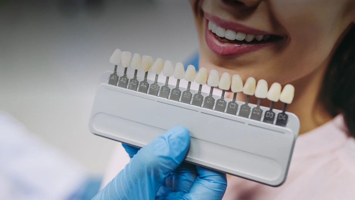 Facettes au Cabinet du Dr Domingues, dentiste à Tigery 91250