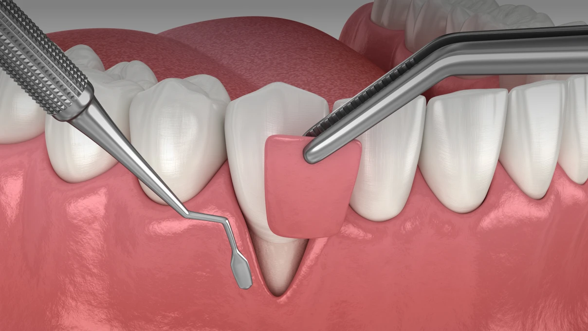 Chirurgie muco-gingivale au Cabinet du Dr Domingues à Tigery 91250