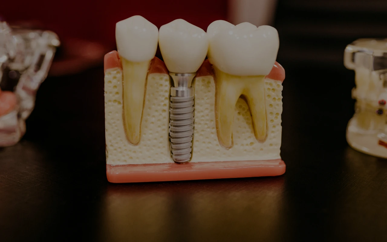 Implant dentaire au Cabinet dentaire du Dr Domingues, dentiste à Tigery 91250