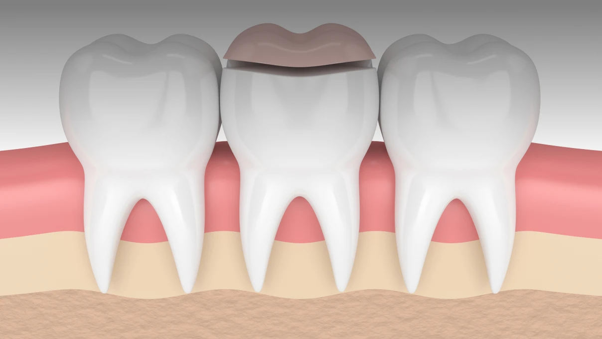 Inlay/onlay au Cabinet du Dr Domingues à Tigery 91250