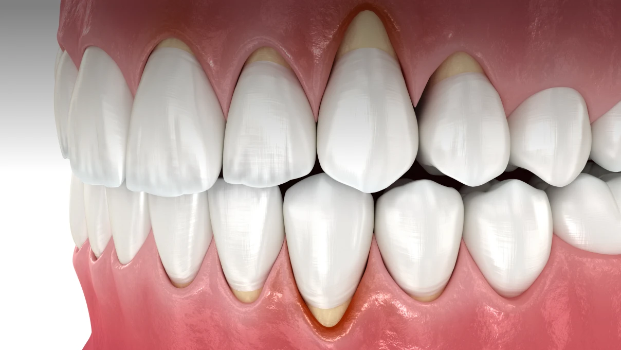 Déchaussement au Cabinet du Dr Domingues, dentiste à Tigery 91250