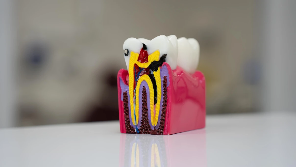 Traitement des caries au Cabinet du Dr Domingues à Tigery 91250