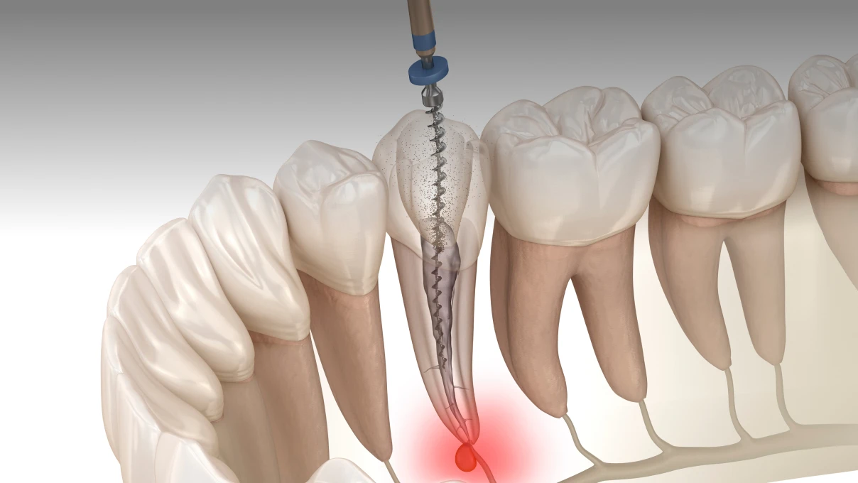 Conserver une dent endommagée au Cabinet du Dr Domingues à Tigery 91250